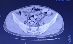 Midesinde 1 Kilo 159 Gram Madde Ele Geçirildi